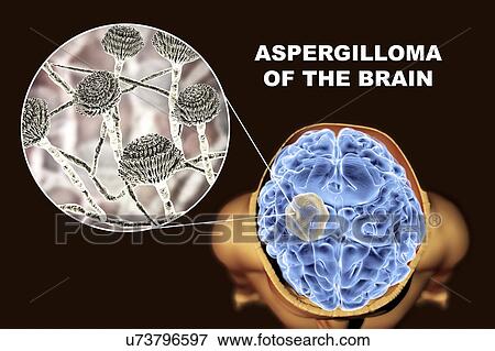 Stock Photo - Aspergilloma of the brain and a close-up view of Aspergillus fungi, computer illustration. Also known as mycetoma, or fungus ball, this is an intracranial lesion produced by Aspergillus fungi in immunocompromised patients.. Fotosearch