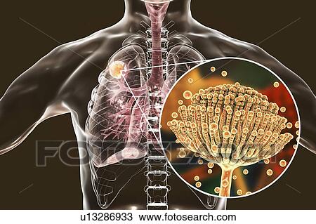 Stock Image - Aspergilloma of the lung and a close-up view of Aspergillus fungi, computer illustration. Also known as mycetoma, or fungus ball, this is an intrapulmonary lesion produced by Aspergillus fungi in immunocompromised patients.. Fotosearch