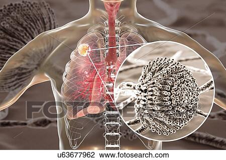 Stock Image - Aspergilloma of the lung and a close-up view of Aspergillus fungi, computer illustration. Also known as mycetoma, or fungus ball, this is an intrapulmonary lesion produced by Aspergillus fungi in immunocompromised patients.. Fotosearch