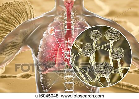 Stock Photo - Aspergilloma of the lung and a close-up view of Aspergillus fungi, computer illustration. Also known as mycetoma, or fungus ball, this is an intrapulmonary lesion produced by Aspergillus fungi in immunocompromised patients.. Fotosearch
