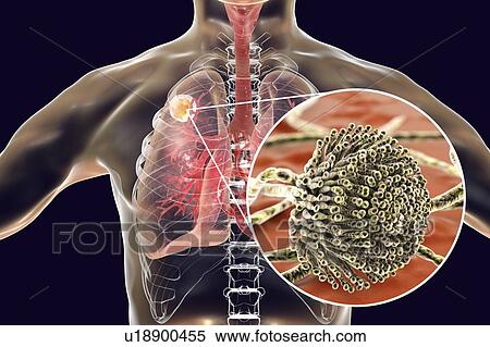 Aspergilloma of the lung and a close-up view of Aspergillus fungi, computer illustration. Also known as mycetoma, or fungus ball, this is an intrapulmonary lesion produced by Aspergillus fungi in immunocompromised patients. View Large Photo Image Stock Photography - Aspergilloma of the lung and a close-up view of Aspergillus fungi, computer illustration. Also known as mycetoma, or fungus ball, this is an intrapulmonary lesion produced by Aspergillus fungi in immunocompromised patients.. Fotosearch
