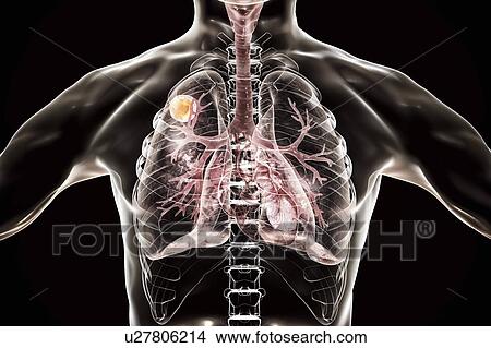 Picture - Aspergilloma of the lung, computer illustration. Also known as mycetoma, or fungus ball, this is an intrapulmonary lesion produced by Aspergillus fungi in immunocompromised patients.. Fotosearch