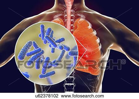 Bacterial pneumonia, conceptual illustration. Human lungs and close-up view of bacteria, one of the causative agents of pneumonia. View Large Photo Image Stock Image - Bacterial pneumonia, conceptual illustration. Human lungs and close-up view of bacteria, one of the causative agents of pneumonia.. Fotosearch