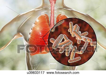 Stock Photo - Bacterial pneumonia, conceptual illustration. Human lungs and close-up view of bacteria, one of the causative agents of pneumonia.. Fotosearch