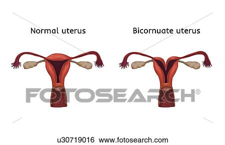 Stock Photograph - Bicornuate uterus and normal uterus comparison, illustration. A bicornuate uterus is composed of two horns separated by a septum.. Fotosearch
