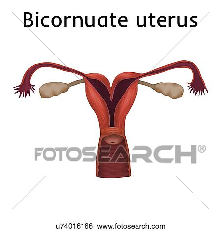 Stock Photograph - Bicornuate uterus, illustration. A bicornuate uterus is composed of two horns separated by a septum.. Fotosearch