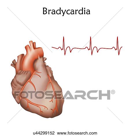Stock Image - Bradycardia, illustration.. Fotosearch