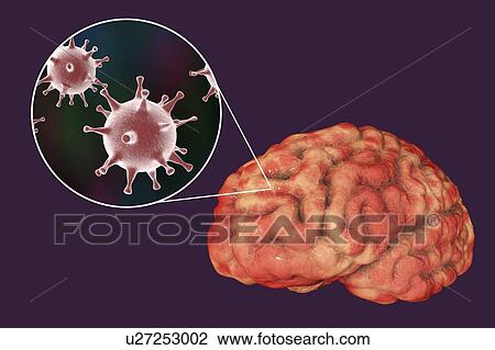 Brain infection caused by Herpes viruses, computer illustration. View Large Photo Image Stock Image - Brain infection caused by Herpes viruses, computer illustration.. Fotosearch
