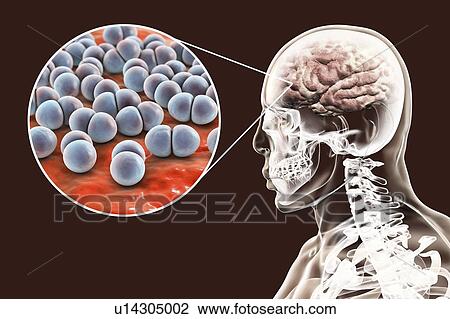 Stock Image - Brain infection caused by Streptococcus pneumoniae bacteria, computer illustration. S. pneumoniae are Gram-positive bacteria arranged in pairs (diplococci), they are common causative agents of infections of different location, including bacterial.... Fotosearch