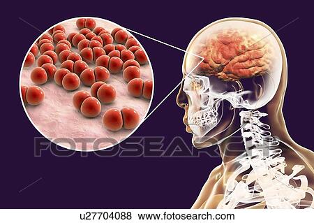 Stock Photo - Brain infection caused by Streptococcus pneumoniae bacteria, computer illustration. S. pneumoniae are Gram-positive bacteria arranged in pairs (diplococci), they are common causative agents of infections of different location, including bacterial.... Fotosearch