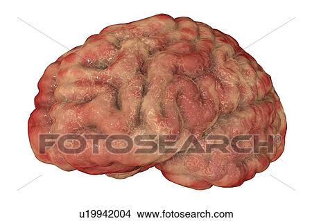 Picture - Brain with encephalitis. Computer illustration showing brain with signs of encephalitis, such as brain edema, haemorrhages and necrosis.. Fotosearch