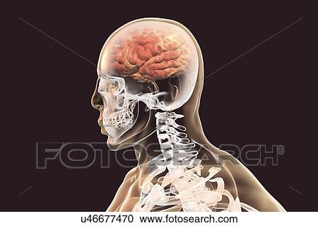 Brain with encephalitis. Computer illustration showing brain with signs of encephalitis, such as brain edema, haemorrhages and necrosis. View Large Photo Image Stock Image - Brain with encephalitis. Computer illustration showing brain with signs of encephalitis, such as brain edema, haemorrhages and necrosis.. Fotosearch