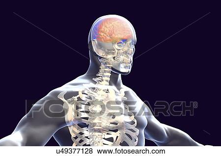 Brain with encephalitis. Computer illustration showing brain with signs of encephalitis, such as brain edema, haemorrhages and necrosis. View Large Photo Image Stock Photo - Brain with encephalitis. Computer illustration showing brain with signs of encephalitis, such as brain edema, haemorrhages and necrosis.. Fotosearch