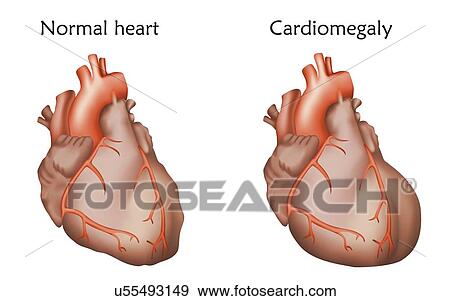 Stock Photo - Cardiomegaly, illustration. Comparison between an enlarged and normal heart.. Fotosearch