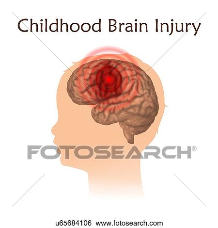 Stock Photograph - Childhood brain injury, illustration. Damaged child's brain.. Fotosearch