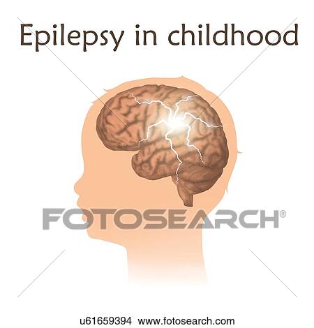 Childhood epilepsy, illustration. Electrical discharge in a child's brain. View Large Photo Image Picture - Childhood epilepsy, illustration. Electrical discharge in a child's brain.. Fotosearch