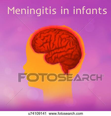 Childhood meningitis, illustration. Meningitis is an acute inflammation of the protective membranes covering the brain and spinal cord. View Large Photo Image Stock Image - Childhood meningitis, illustration. Meningitis is an acute inflammation of the protective membranes covering the brain and spinal cord.. Fotosearch