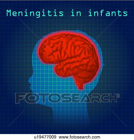 Stock Photo - Childhood meningitis, illustration. Meningitis is an acute inflammation of the protective membranes covering the brain and spinal cord.. Fotosearch