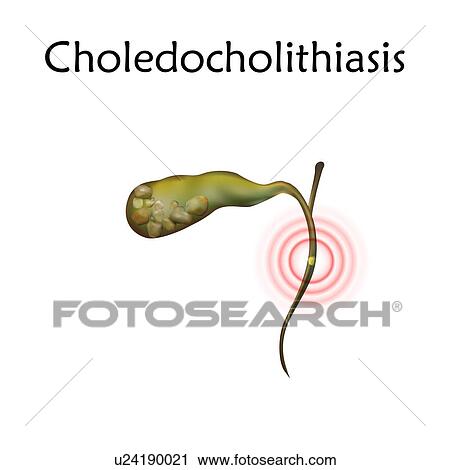 Stock Image - Choledocholithiasis, illustration. This is a condition where a gallstone (or stones) blocks the common bile duct.. Fotosearch