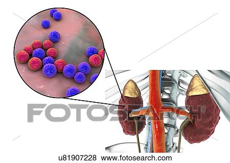 Chronic pyelonephritis caused by Enterococcus sp. bacteria. Illustration showing the irregular scarred cortical surface of the kidney and a close-up view of Enterococcus bacteria. View Large Photo Image Stock Photo - Chronic pyelonephritis caused by Enterococcus sp. bacteria. Illustration showing the irregular scarred cortical surface of the kidney and a close-up view of Enterococcus bacteria.. Fotosearch