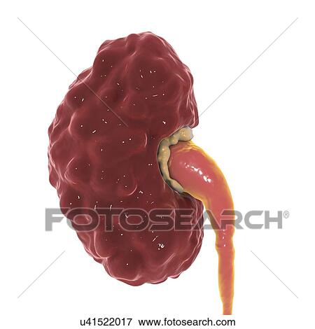 Stock Photo - Chronic pyelonephritis, computer illustration. The affected kidney has an irregular scarred cortical surface, dilated and blunted calyces (yellow), and a dilated ureter.. Fotosearch