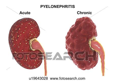 Stock Photo - Comparison of gross anatomy of acute and chronic pyelonephritis, illustration. There are small abscesses (yellow) on the surface of the kidney with acute pyelonephritis (left). The kidney with chronic pyelonephritis (right) has an irregular scarred.... Fotosearch