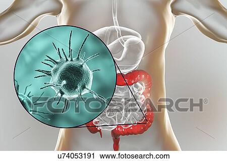 Computer illustration of abstract pathogenic microorganisms in human large intestine. View Large Photo Image Stock Image - Computer illustration of abstract pathogenic microorganisms in human large intestine.. Fotosearch