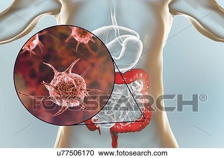 Computer illustration of abstract pathogenic microorganisms in human large intestine. View Large Photo Image Stock Image - Computer illustration of abstract pathogenic microorganisms in human large intestine.. Fotosearch