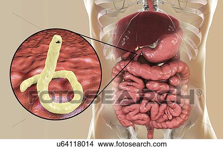 Picture - Computer illustration of the parasitic hookworm Ancylostoma duodenale in the small intestine. This is one of the commonest causes of hookworm infestation in humans, particularly in sub-tropical regions such as North Africa and India. The worm's head.... Fotosearch