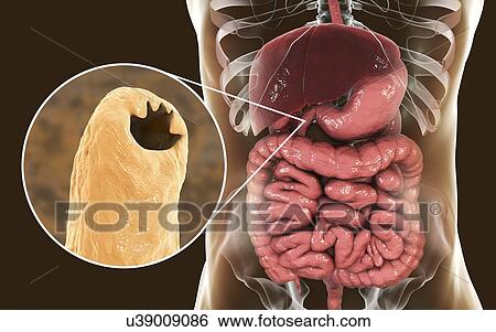 Computer illustration of the parasitic hookworm Ancylostoma duodenale in the small intestine. This is one of the commonest causes of hookworm infestation in humans, particularly in sub-tropical regions such as North Africa and India. The worm's head... View Large Photo Image Stock Photograph - Computer illustration of the parasitic hookworm Ancylostoma duodenale in the small intestine. This is one of the commonest causes of hookworm infestation in humans, particularly in sub-tropical regions such as North Africa and India. The worm's head.... Fotosearch