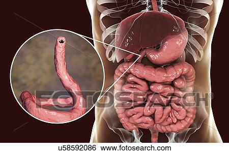 Computer illustration of the parasitic hookworm Ancylostoma duodenale in the small intestine. This is one of the commonest causes of hookworm infestation in humans, particularly in sub-tropical regions such as North Africa and India. The worm's head... View Large Photo Image Stock Photograph - Computer illustration of the parasitic hookworm Ancylostoma duodenale in the small intestine. This is one of the commonest causes of hookworm infestation in humans, particularly in sub-tropical regions such as North Africa and India. The worm's head.... Fotosearch