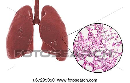 Stock Image - Computer illustration showing human lung anatomy and a light micrograph of a section through healthy lung tissue showing alveoli (air sacs, white). The alveoli are the site of gaseous exchange, where oxygen enters the blood and carbon dioxide is removed.. Fotosearch