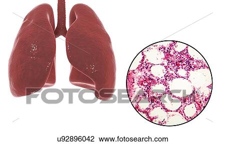 Computer illustration showing human lung anatomy and a light micrograph of a section through healthy lung tissue showing alveoli (air sacs, white). The alveoli are the site of gaseous exchange, where oxygen enters the blood and carbon dioxide is removed. View Large Photo Image Stock Image - Computer illustration showing human lung anatomy and a light micrograph of a section through healthy lung tissue showing alveoli (air sacs, white). The alveoli are the site of gaseous exchange, where oxygen enters the blood and carbon dioxide is removed.. Fotosearch