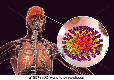 Computer illustrations showing the common complications of flu infection, such as encephalitis and pneumonia. View Large Photo Image Stock Image - Computer illustrations showing the common complications of flu infection, such as encephalitis and pneumonia.. Fotosearch