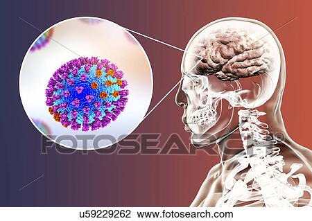Stock Image - Computer illustrations showing the common complication of flu infection, such as encephalitis.. Fotosearch