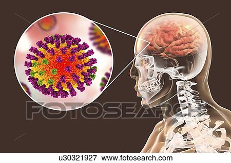 Stock Photo - Computer illustrations showing the common complication of flu infection, such as encephalitis.. Fotosearch