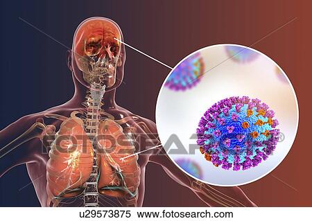 Stock Photography - Computer illustrations showing the common complications of flu infection, such as encephalitis and pneumonia.. Fotosearch