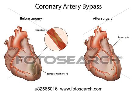 Stock Photograph - Coronary artery bypass, illustration. The bypass graft restores normal blood flow to an obstructed coronary artery.. Fotosearch