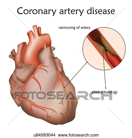 Coronary artery disease, illustration. A blocked coronary artery has led to heart muscle damage. View Large Photo Image Picture - Coronary artery disease, illustration. A blocked coronary artery has led to heart muscle damage.. Fotosearch