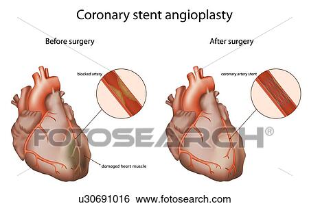 Stock Photograph - Coronary stent angioplasty, illustration. The coronary stent opens a clogged heart artery.. Fotosearch