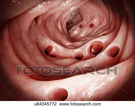 Stock Image - Diverticulosis in large intestine, illustration. Diverticulosis causes sacs (diverticula, shown here) to form and protrude externally from the colon wall (large intestine). These can become inflamed, infected, and may rupture (diverticulitis)..... Fotosearch