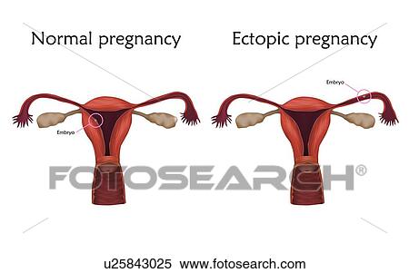 Ectopic and normal pregnancy, illustration. In an ectopic pregnancy the embryo implants in the fallopian tube, not in the uterus. View Large Photo Image Stock Photography - Ectopic and normal pregnancy, illustration. In an ectopic pregnancy the embryo implants in the fallopian tube, not in the uterus.. Fotosearch