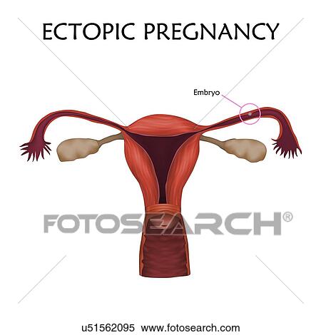 Ectopic pregnancy, illustration. The embryo has implanted in the fallopian tube, not in the uterus. View Large Photo Image Stock Photography - Ectopic pregnancy, illustration. The embryo has implanted in the fallopian tube, not in the uterus.. Fotosearch