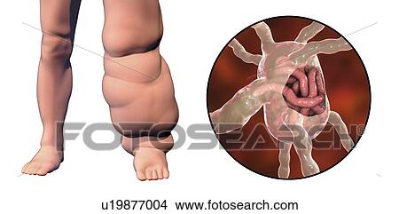 Elephantiasis. Computer illustration of the leg of a person affected by elephantiasis, also known as lymphatic filariasis. This disease is caused by parasitic nematode worms transmitted in larval form by the bite of mosquitoes. The larvae develop into... View Large Photo Image Picture - Elephantiasis. Computer illustration of the leg of a person affected by elephantiasis, also known as lymphatic filariasis. This disease is caused by parasitic nematode worms transmitted in larval form by the bite of mosquitoes. The larvae develop into.... Fotosearch