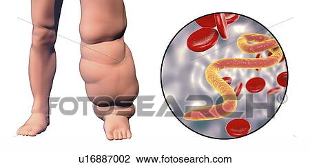 Elephantiasis. Computer illustration of the leg of a person affected by elephantiasis, also known as lymphatic filariasis, and close-up view of microfilaria in patient's blood. This disease is caused by parasitic nematode worms transmitted in larval... View Large Photo Image Stock Image - Elephantiasis. Computer illustration of the leg of a person affected by elephantiasis, also known as lymphatic filariasis, and close-up view of microfilaria in patient's blood. This disease is caused by parasitic nematode worms transmitted in larval.... Fotosearch