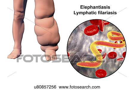 Stock Photograph - Elephantiasis. Computer illustration of the leg of a person affected by elephantiasis, also known as lymphatic filariasis, and close-up view of microfilaria in patient's blood. This disease is caused by parasitic nematode worms transmitted in larval.... Fotosearch