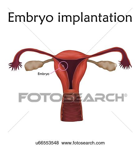 Stock Photo - Embryo implantation, illustration.. Fotosearch