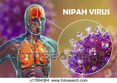 Picture - Encephalitis and pneumonia caused by Nipah viruses, computer illustration. Nipah virus is zoonotic (transmitted to humans from animals) and was first found in Malaysia and Singapore in people who had close contact with pigs. It was initially isolated.... Fotosearch