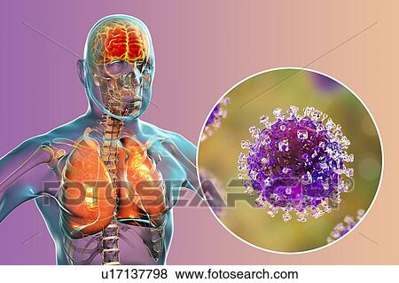 Stock Photo - Encephalitis and pneumonia caused by Nipah viruses, computer illustration. Nipah virus is zoonotic (transmitted to humans from animals) and was first found in Malaysia and Singapore in people who had close contact with pigs. It was initially isolated.... Fotosearch
