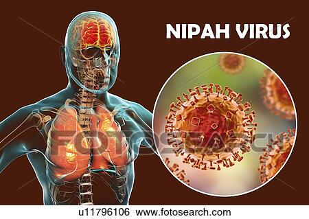 Stock Photograph - Encephalitis and pneumonia caused by Nipah viruses, computer illustration. Nipah virus is zoonotic (transmitted to humans from animals) and was first found in Malaysia and Singapore in people who had close contact with pigs. It was initially isolated.... Fotosearch